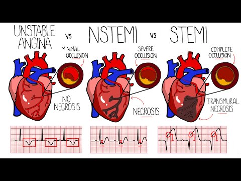 Stable vs Unstable Angina: Navigating Heart Health Solutions