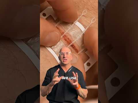 Revolutionizing Recovery with Advanced Surgical Staples