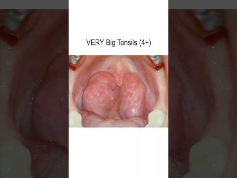 Uncover the Hidden Triggers of Tonsillitis Today
