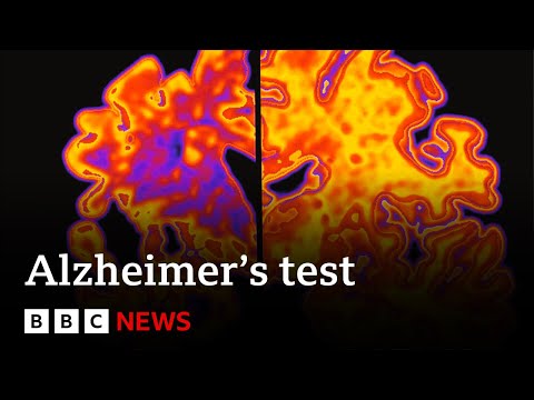 Revolutionizing Alzheimer's Treatment with Smart Technology