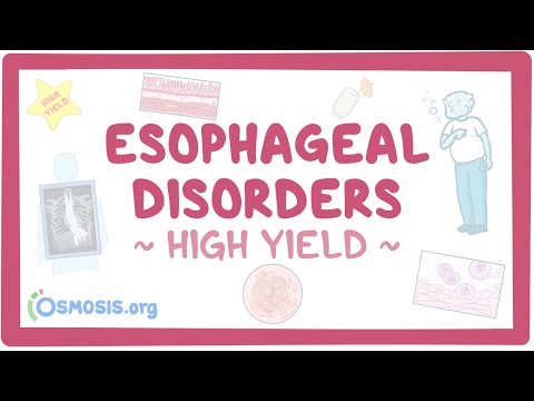 Innovative Solutions for Esophageal Web Management and Care