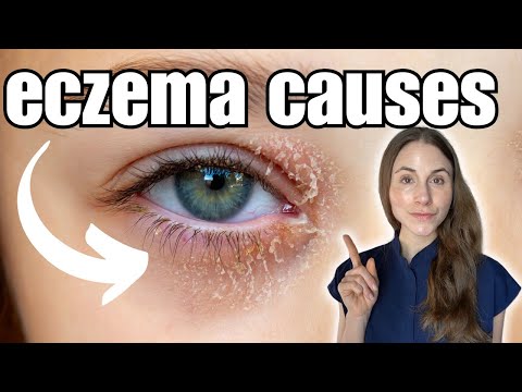 Top Eye Creams for Eczema Relief on Sensitive Eyelids