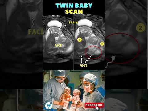 Twin Pregnancy Revolution: Embracing Tech for Double Joy