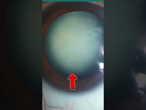 Revitalize Your Look with Advanced Cat Eye Surgery Solutions