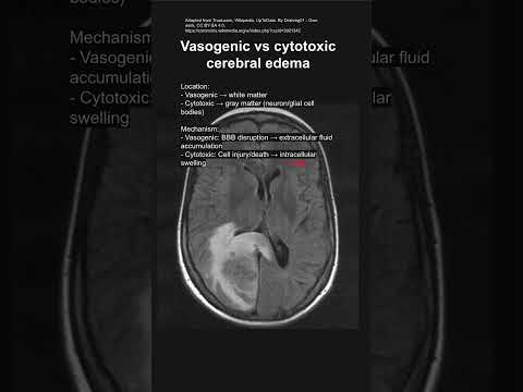 Vasogenic Oedema Unveiled: Innovations in Medical Solutions