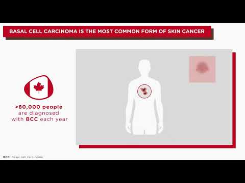Tech Solutions for Understanding Basal Carcinoma Today