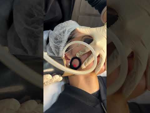 Revolutionizing Beauty and Precision with CO2 Laser Tech