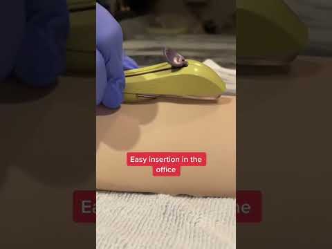 LARC Contraception: Smart Choices for Better Health