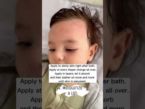 Soothing Solutions for Your Baby's Eczema Rash Today