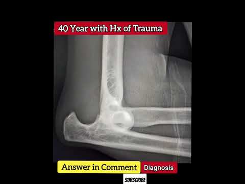 Revolutionize Diagnosis with Advanced Elbow X Ray Technology