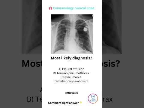 Revolutionizing Pneumothorax Diagnosis with X-Ray Insights