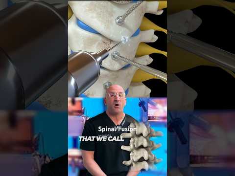 Cervical Fusion Breakthroughs for a Pain-Free Future