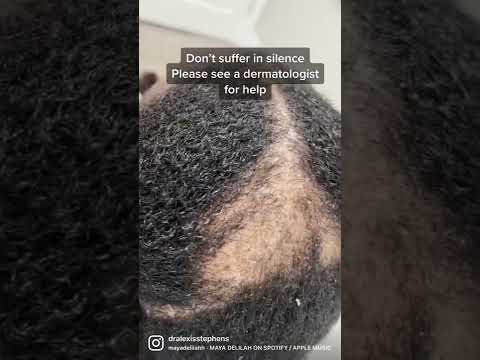 Revitalize Your Look: Solutions for Hair Receding Challenges