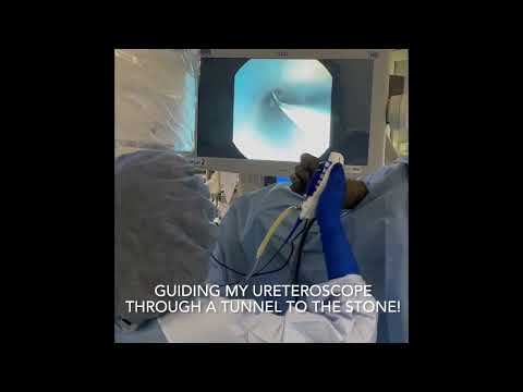 Laser Lithotripsy: A Breakthrough in Kidney Stone Treatment