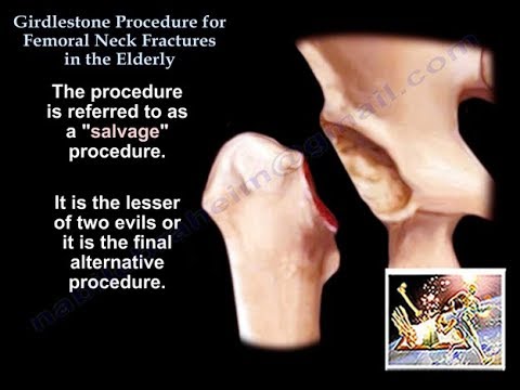 Revolutionizing Recovery with the Girdlestone Procedure