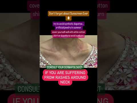 Neck Rash Alert: Quick Solutions for Unexpected Skin Issues