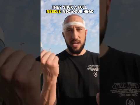 Revolutionary Hair Implants: Transforming Your Look with Tech