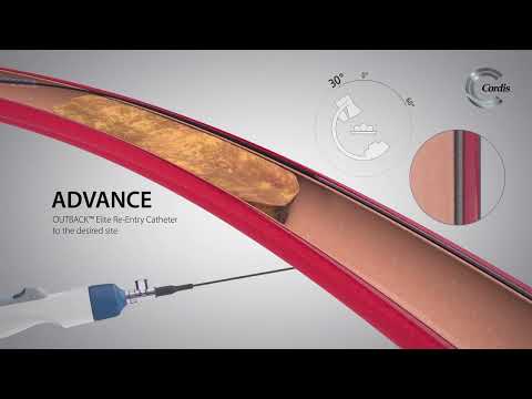 Revolutionizing Healthcare with Cordis Catheter Technology