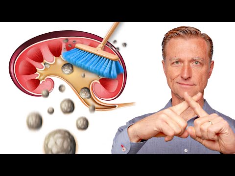Soothe Kidney Stones Naturally with These Remedies