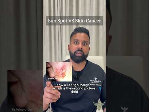 Understanding Benign Melanoma in Modern Skin Care Tech
