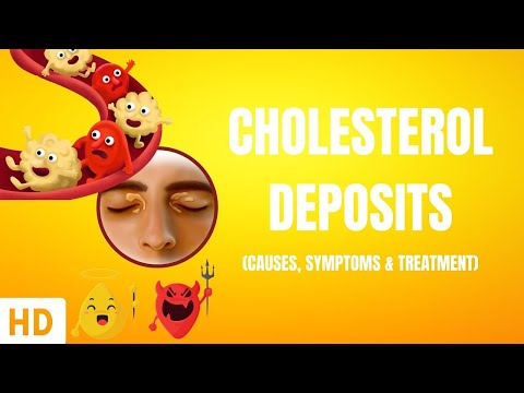 Clear Vision: Addressing Cholesterol Deposits in Eyes