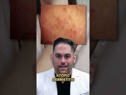 Rash on Wrist: Unraveling Causes and Solutions Today