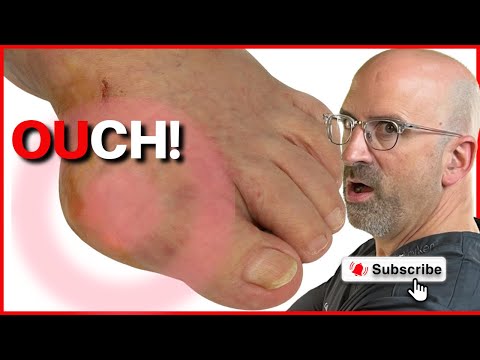 Relief Revolution: Innovative Anti-Inflammatory Solutions for Gout