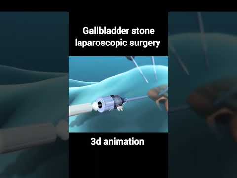 Revolutionizing Bladder Removal Surgery with Cutting-Edge Tech