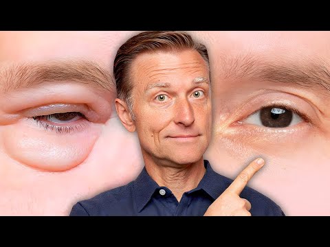 Tech Solutions for Puffy Eyes Caused by Allergies