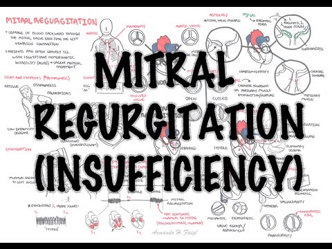 Revolutionizing Heart Health: Understanding Mitral Regurgitation Murmurs