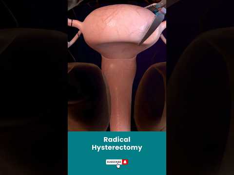 Revolutionizing Radical Hysterectomy with Cutting-Edge Tech