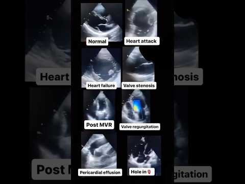 Unveiling the Power of Normal Chest Radiographs in Tech
