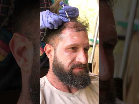 Revolutionary Solutions for Male Pattern Baldness Treatment