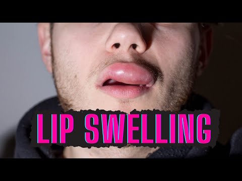 One-Sided Lip Swelling: Causes and High-Tech Solutions