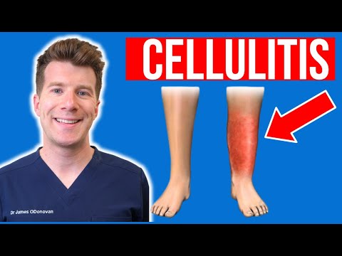 Natural Solutions for Fast Relief from Cellulitis Today