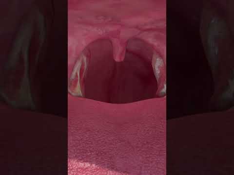 Red Spot on Tonsil: What Your Health App Can Reveal