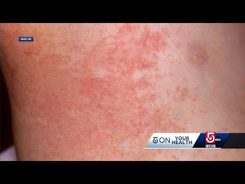 Harnessing Tech to Tackle Red Rash Solutions Today