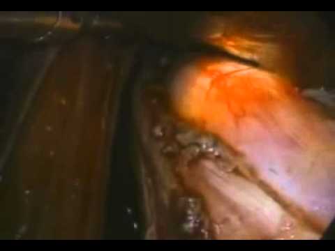 Revolutionizing Esophageal Care with Heller Myotomy Techniques