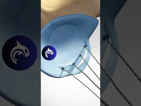 Revolutionizing Bankart Repair with Cutting-Edge Technology