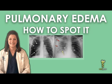 Understanding Pulmonary Edema Through Chest X Ray Insights