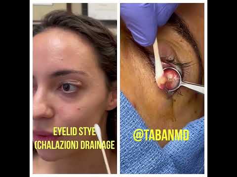 Tech-Driven Chalazion Removal for Clearer Vision Today