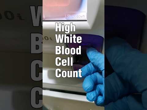 Revolutionizing Urine Cancer Detection with White Blood Cells