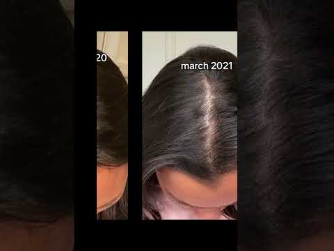 Revitalize Your Look with Local Hair Loss Solutions Today