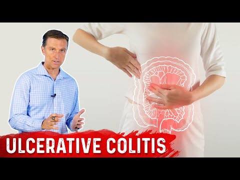 Unraveling the Triggers Behind Ulcerative Colitis
