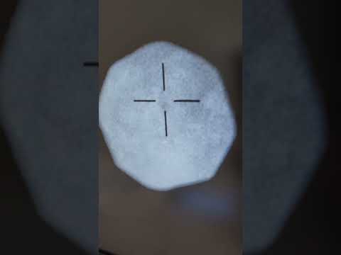 Crushing Kidney Stones in Men: Tech Solutions Revealed