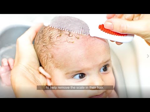 Soothe Infant Dry Scalp with Innovative Solutions Today