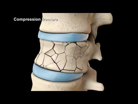 Revolutionize Your Spine Health with Kyphoplasty Surgery