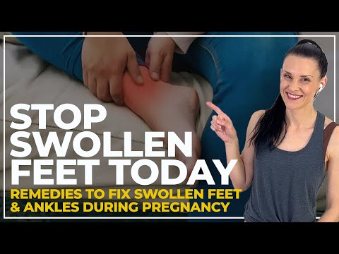 Relief at Your Feet: Smart Solutions for Swollen Legs in Pregnancy