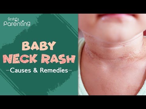 Neck Rash Solutions: Your Path to Comfort and Clarity