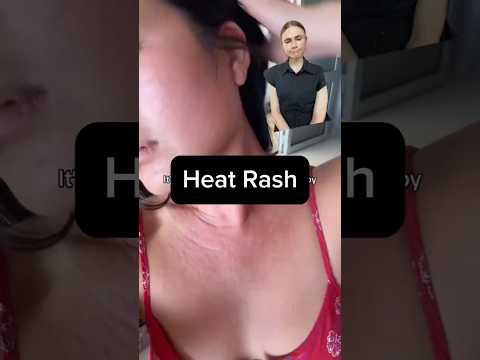 Beat Heat Rash Groin with Innovative Solutions Today